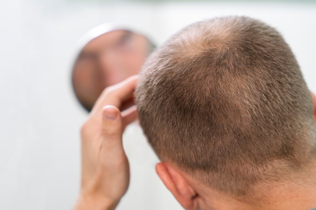 adult-male-having-balding-problems