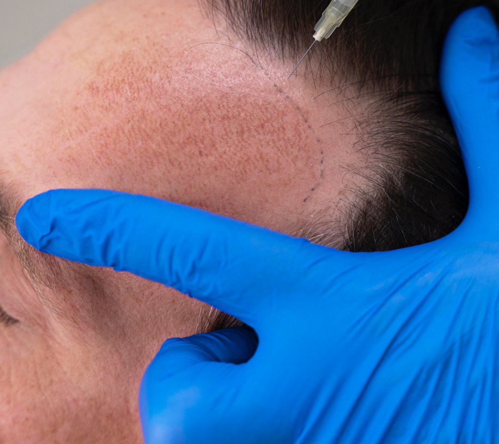 man-getting-hair-loss-treatment