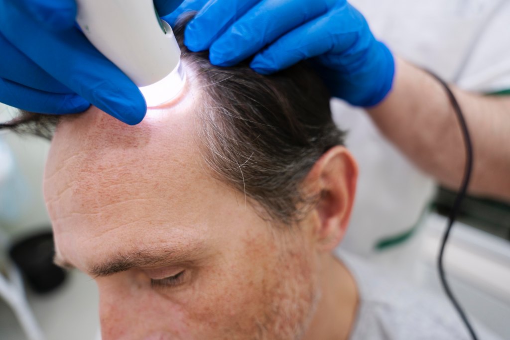 man-getting-hair-loss-treatment
