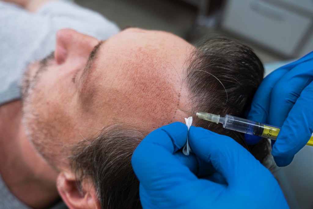 man-getting-hair-loss-treatment(1)