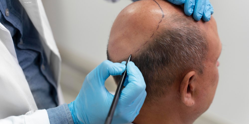 man-going-through-follicular-unit-extraction-process