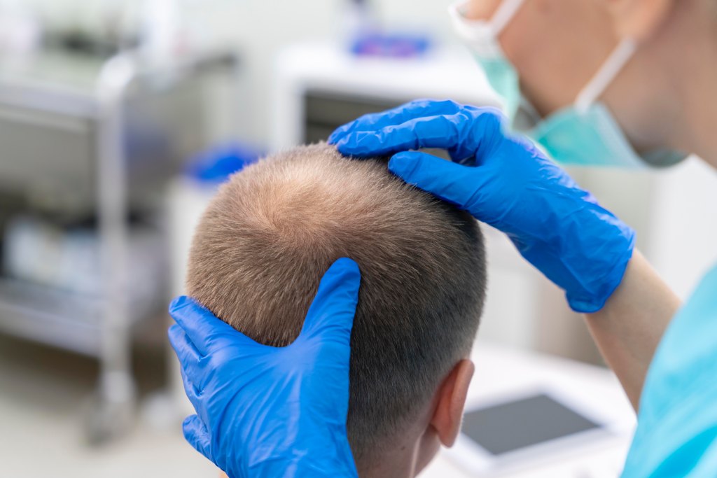 mature-man-having-balding-problems(1)